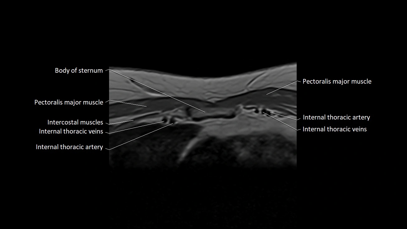 MRI sternum and sternoclavicular joint labeled axial anatomy image 15.webp
